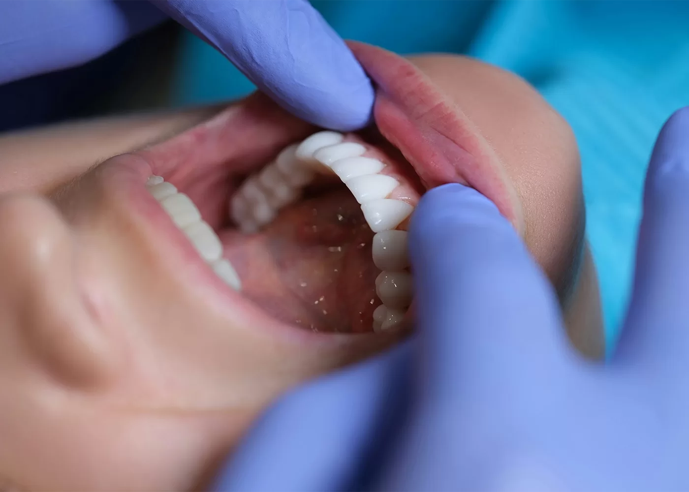 A close-up of a person with their mouth open during a dental examination. Gloved hands are gently adjusting their upper lip to reveal the teeth. The background shows a blue dental bib.