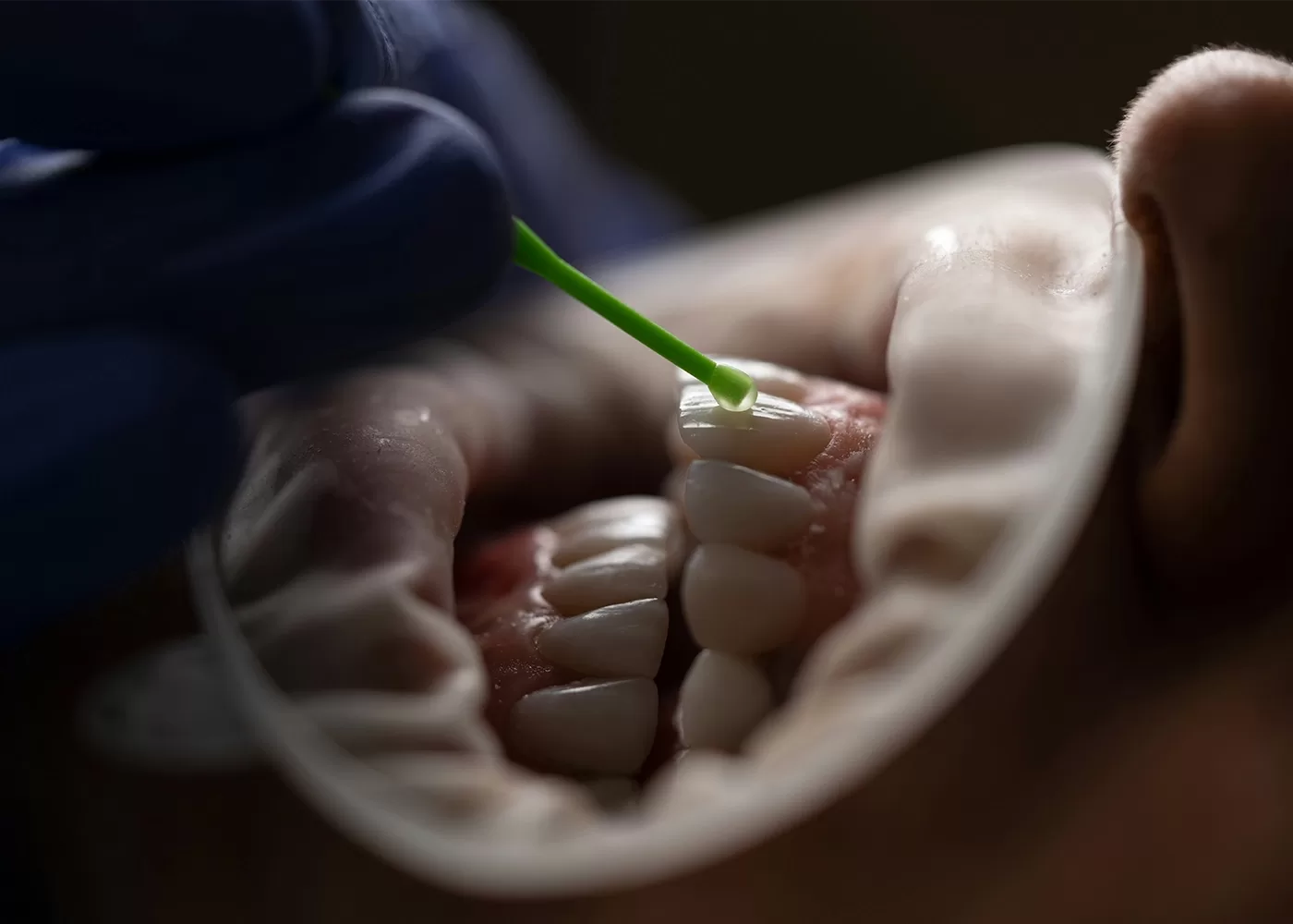 A dental procedure in progress with a close-up view of a persons mouth. A gloved hand is applying a substance to a tooth using a green applicator. White teeth and gums are visible within a dental cheek retractor.