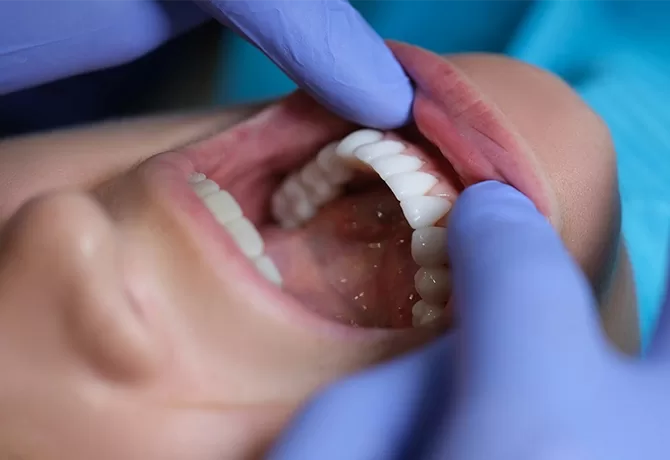 A close-up image of a persons mouth open wide during a dental examination. A gloved hand is holding the upper lip to reveal the teeth and gums.