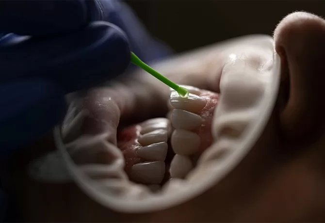 A close-up of a dental procedure showing a dentist applying a whitening treatment to a persons teeth using a small brush. The persons mouth is held open with a dental cheek retractor. The dentists gloved hand is visible.